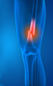 Knee Fracture - Educational Picture