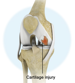 Knee Injury - Educational Picture