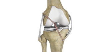 Knee Ligament Reconstruction - Educational Picture