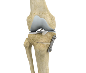 Knee Osteotomy - Educational Picture