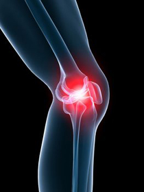 Knee Pain - Educational Picture
