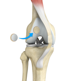 Knee Preservation Surgery - Educational Picture