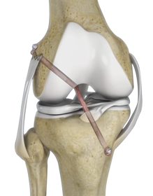 Knee Reconstruction - Educational Picture