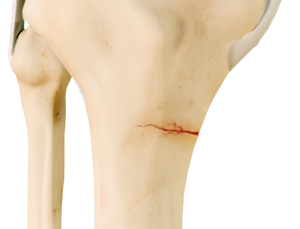 Knee Stress Fractures - Educational Picture