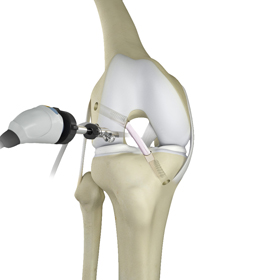 Knee Trauma Reconstruction - Educational Picture