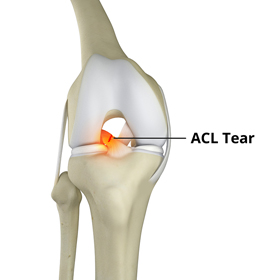 Knee Trauma - Educational Picture