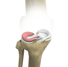 Lateral Meniscus Syndrome - Educational Picture