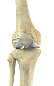 LPFL Reconstruction - Educational Picture