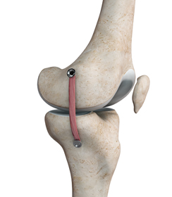 MCL Reconstruction - Educational Picture