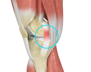 MCL Sprains - Educational Picture