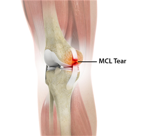 MCL Tears - Educational Picture