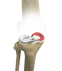 Medial Meniscus Syndrome - Educational Picture