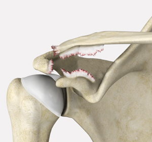 Meniscal Repair Surgery - Educational Picture