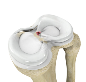 Meniscus Root Tear - Educational Picture