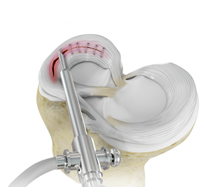 Meniscal Surgery - Educational Picture