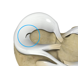 Meniscal Tears - Educational Picture