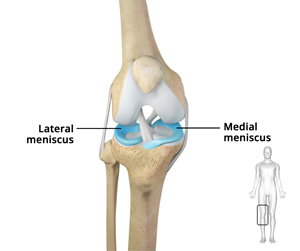 Meniscectomy - Educational Picture