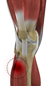 Muscle Injuries  - Educational Picture