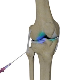 Nonoperative Management of Knee Arthritis - Educational Picture