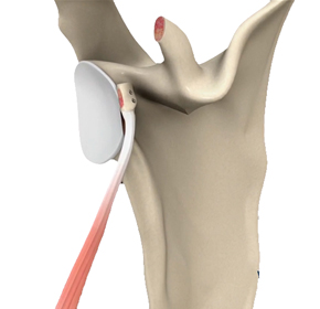 Open Shoulder Stabilization - Educational Picture