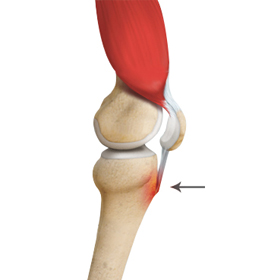 Osgood Schlatter Disease - Educational Picture