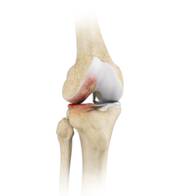 Osteoarthritis Management - Educational Picture