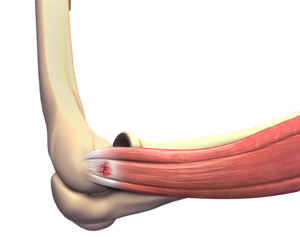 Overuse Injuries  - Educational Picture