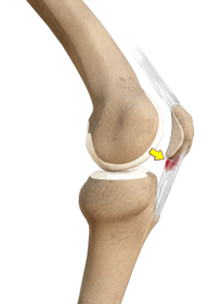 Patellar Tendonitis - Educational Picture