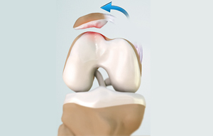 Patellofemoral Instability - Educational Picture