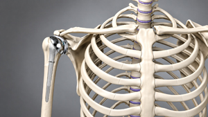 Patient-Specific Shoulder Replacement - Educational Picture