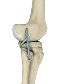 Posterolateral Corner Reconstruction - Educational Picture