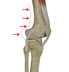 Posterolateral Instability - Educational Picture
