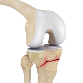 Proximal Tibia Fracture - Educational Picture