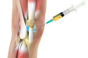 Platelet-Rich Plasma (PRP) Injections for the Knee - Educational Picture