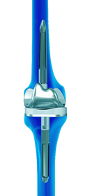 Revision Knee Surgery - Educational Picture