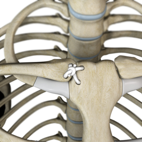 SC Joint Injury Reconstruction - Educational Picture