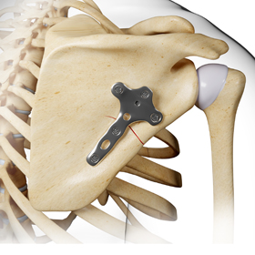 Scapular Reconstruction  - Educational Picture