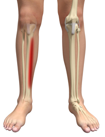Shin Splints - Educational Picture
