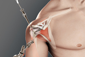 Shoulder Arthroscopy - Educational Picture