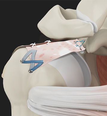 Shoulder Capsular Repair - Educational Picture