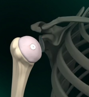 Shoulder Cartilage Restoration - Educational Picture