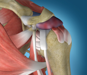 Shoulder Impingement - Educational Picture