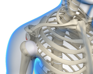 Shoulder Instability - Educational Picture