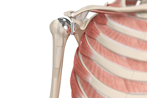 Shoulder Joint Replacement - Educational Picture