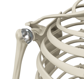 Shoulder Resurfacing - Educational Picture