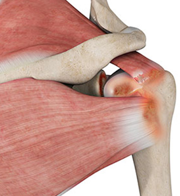 Shoulder Sports Injuries - Educational Picture