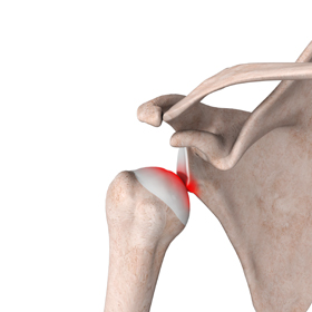 Shoulder Stabilization - Educational Picture