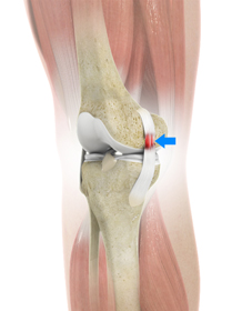 Sprains and Strains - Educational Picture