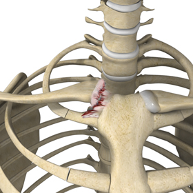 Sternoclavicular Joint Reconstruction - Educational Picture