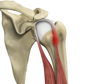 Tendinitis - Educational Picture